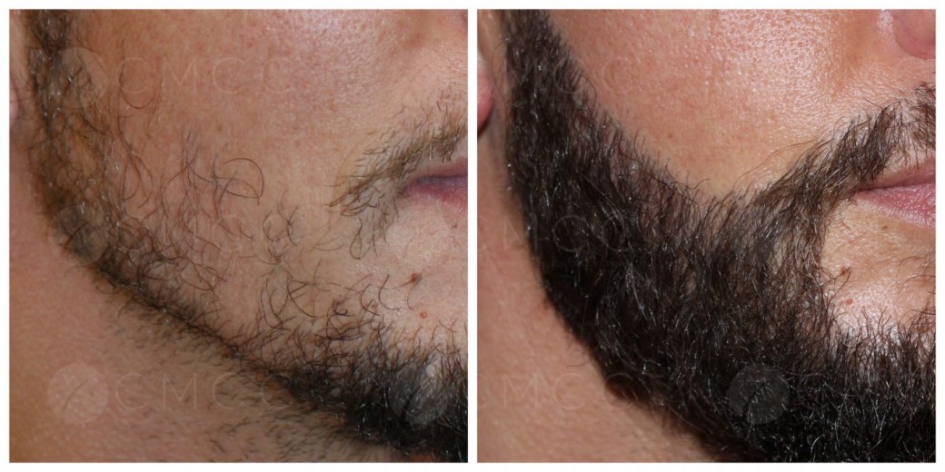 Beard and Mustache Transplant