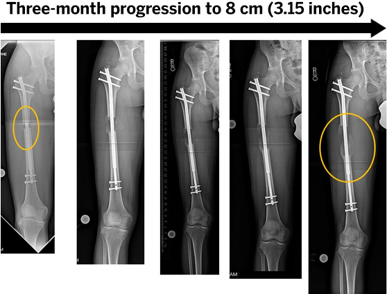 Limb Lengthening