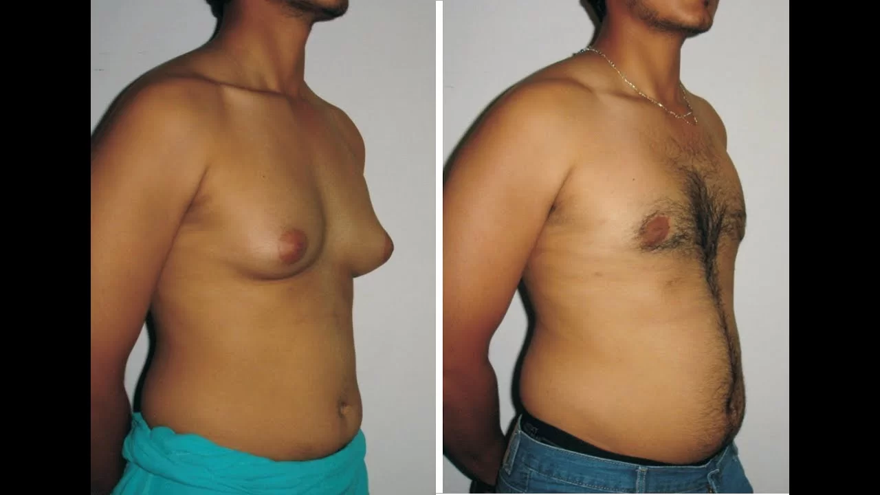 Gynecomastia 