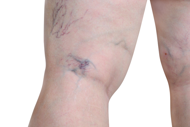 Varicose Veins Treatment