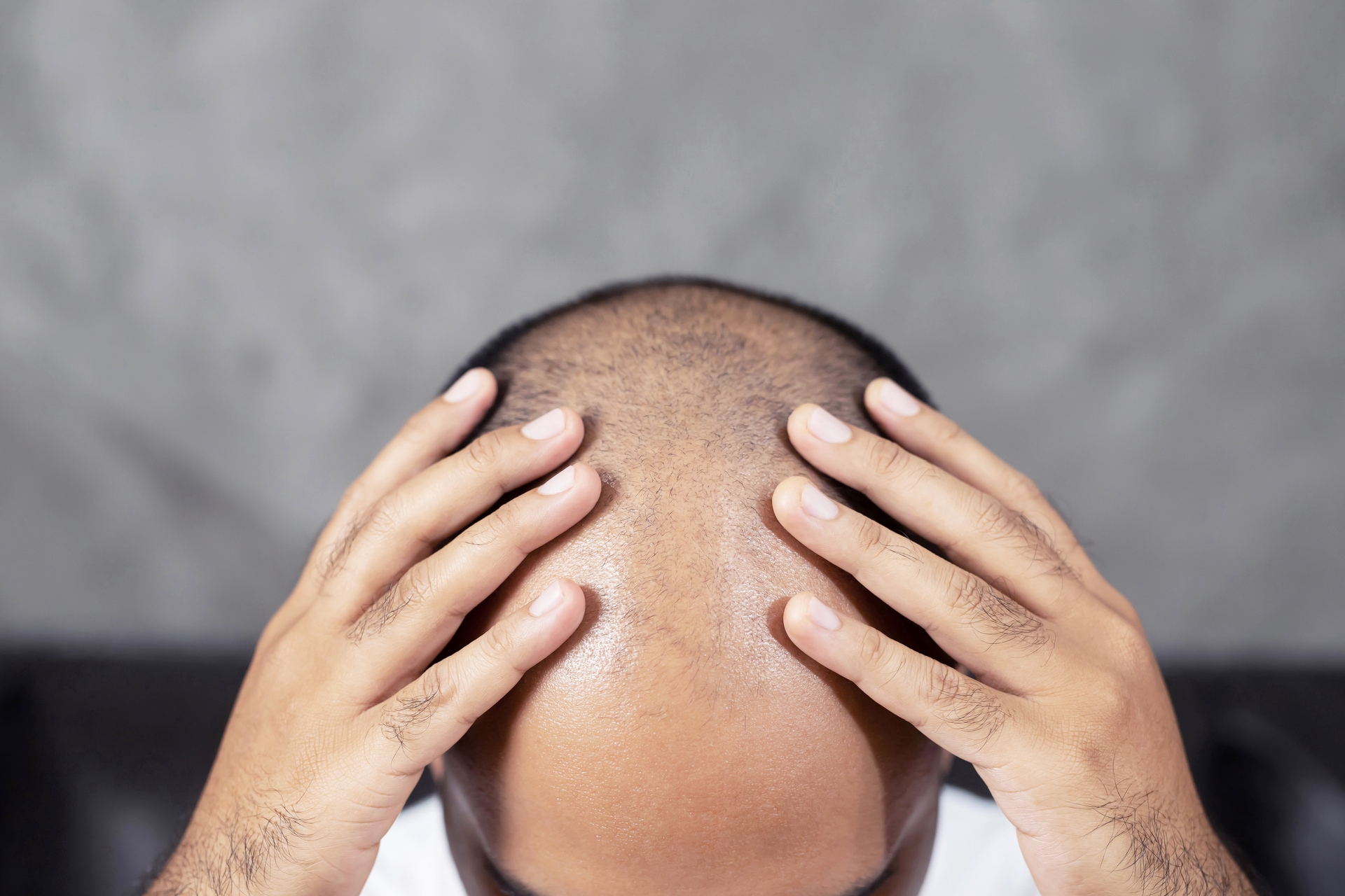 Choosing the Right Hair Transplant: A Step-by-Step Guide to DHI and FUE Decision-Making